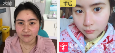 超级微拉美