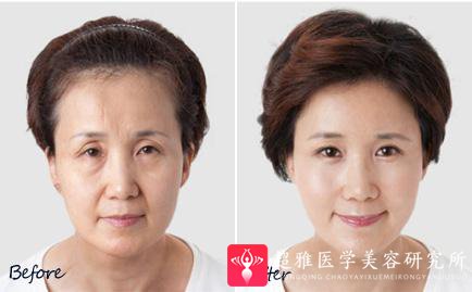 超级微拉美