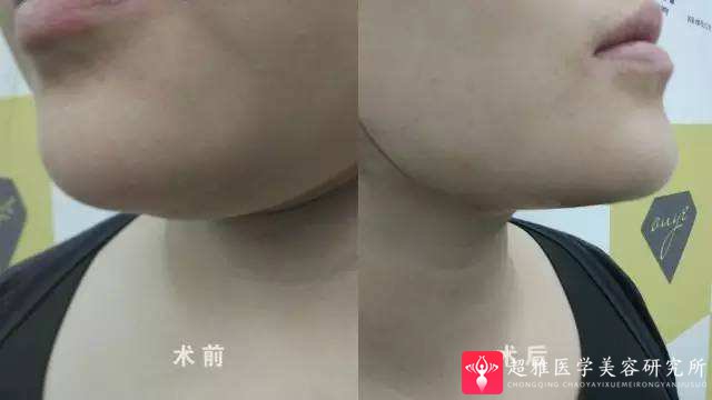 超级微拉美