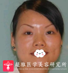 超声波瘦脸