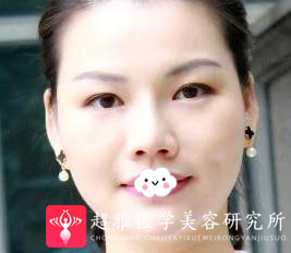 超声波瘦脸