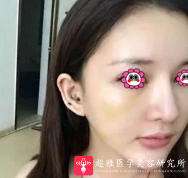 超级微拉美