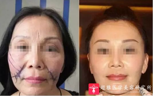 超级微拉美