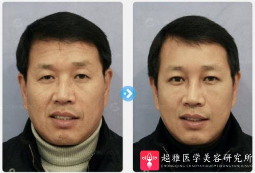 面部提升