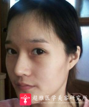 自体脂肪丰面