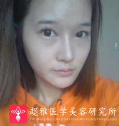 自体脂肪丰面