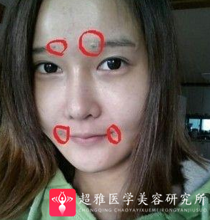 自体脂肪丰面