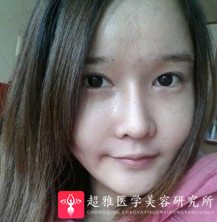 自体脂肪丰面