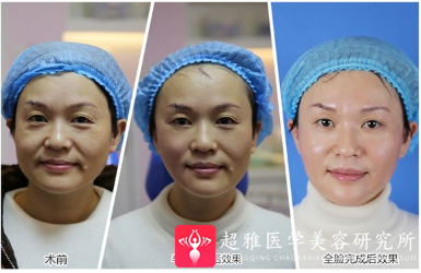 超级微拉美