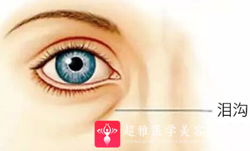 长效玻尿酸