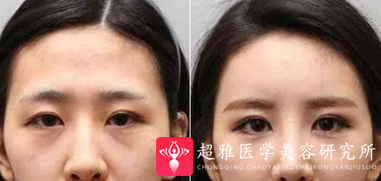 长效玻尿酸