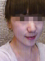 超声波瘦脸