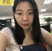 超声波瘦脸