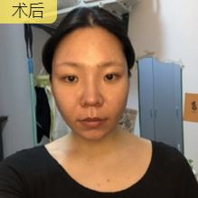 超声波瘦脸