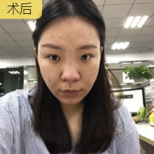 超声波瘦脸