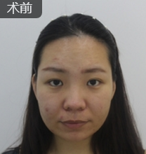 超声波瘦脸