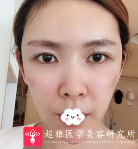 自体脂肪丰面