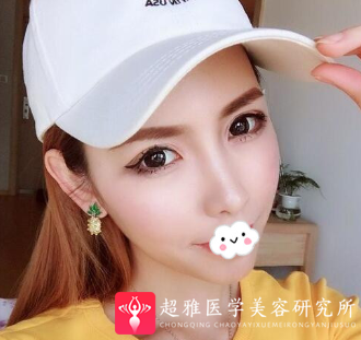 自体脂肪丰面