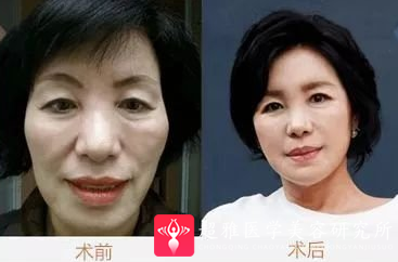 面部提升术