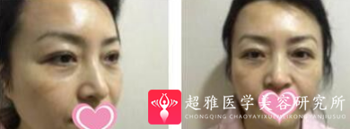 面部提升术