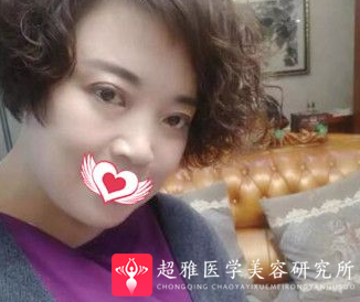 面部提升术