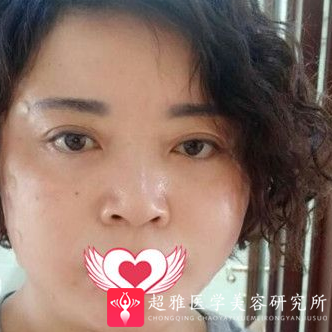 面部提升术