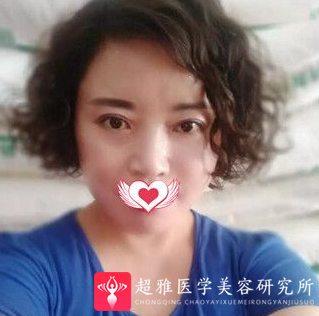 面部提升术