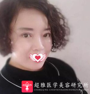 面部提升术