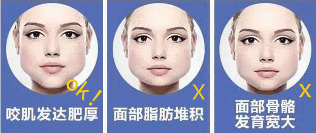 瘦脸针