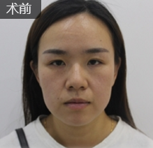 超声波瘦脸