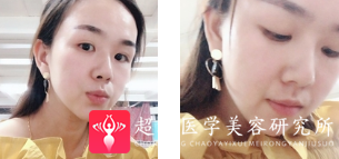 超声波瘦脸