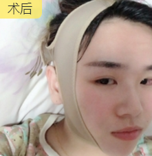 超声波瘦脸
