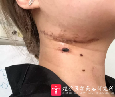 超声波瘦脸