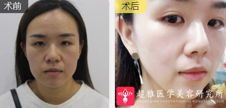 超声波瘦脸
