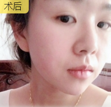 超声波瘦脸