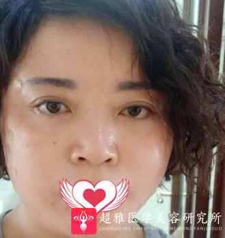 面部提升术