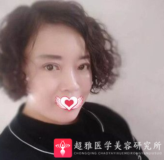 面部提升术