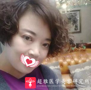 面部提升术