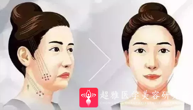 面部提升术