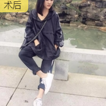 自体脂肪丰面
