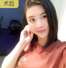 自体脂肪丰面
