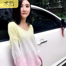 自体脂肪丰面