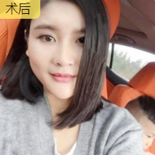 自体脂肪丰面