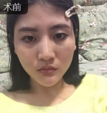 自体脂肪丰面