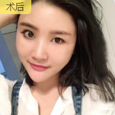自体脂肪丰面
