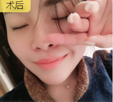 玻尿酸填充术