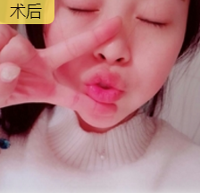 玻尿酸填充术