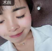 玻尿酸填充术