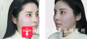 面部提升术