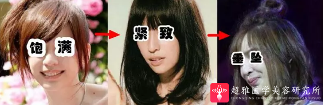 面部提升术